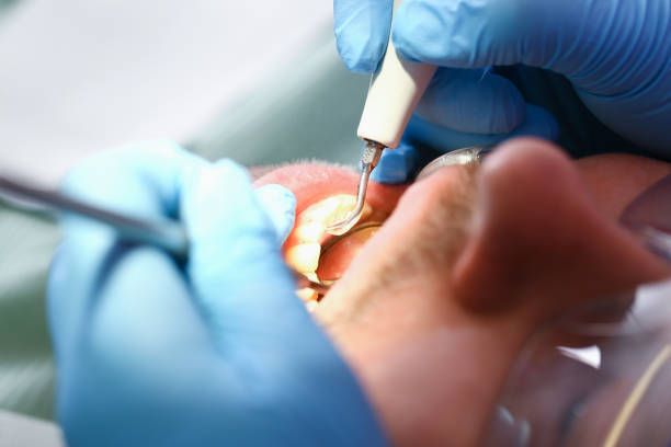 Best Emergency Root Canal Treatment in Franklin Square, NY